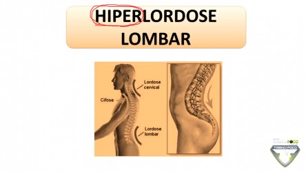 Hiperlordose lombar – Como identificar através do método