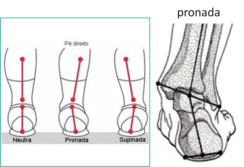 pés pronados e supinados