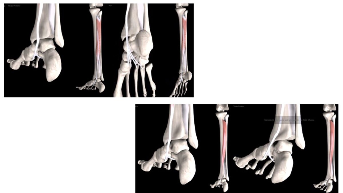 Tríceps Sural - Gastrocnêmicos e Sóleo.8