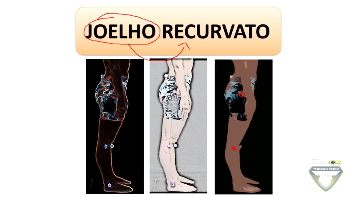 joelho_recurvato_treino_em_foco_avaliação_postural_biofotogrametria_
