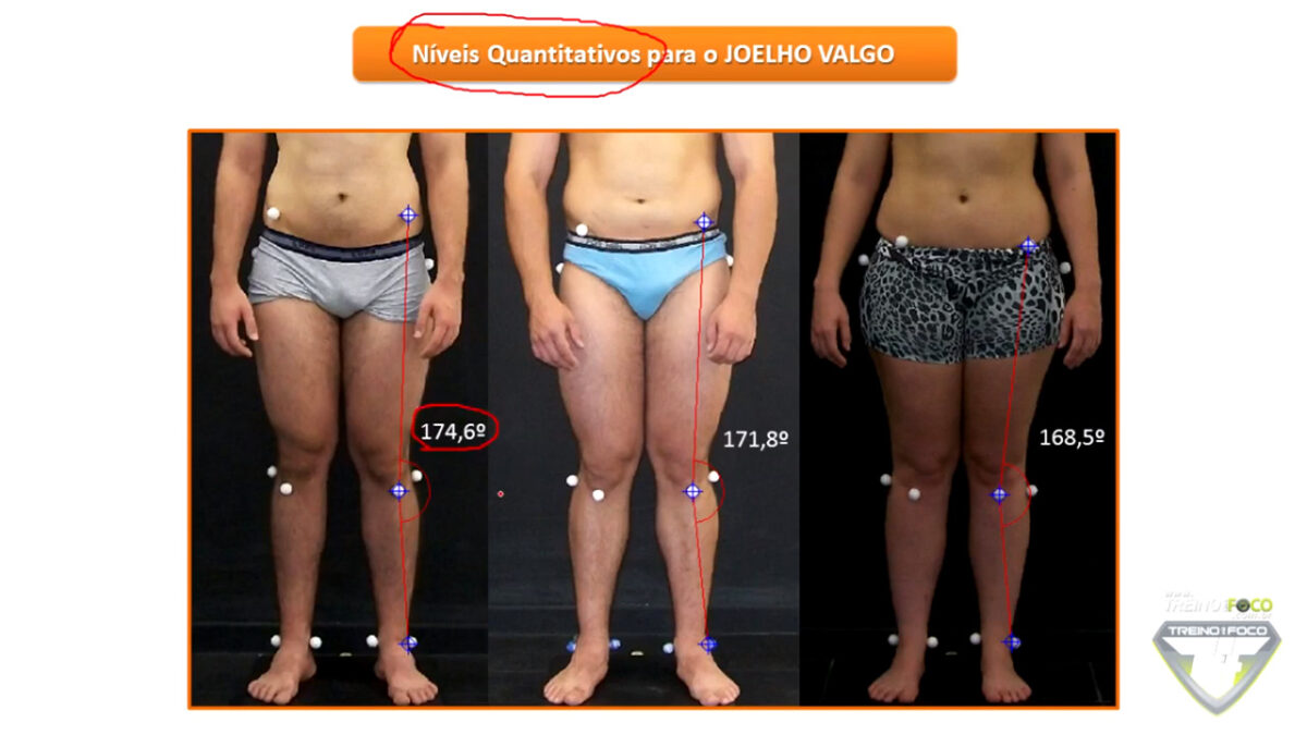 joelho_valgo_avaliação_postural_dores_no_joelho_treino_em_foco