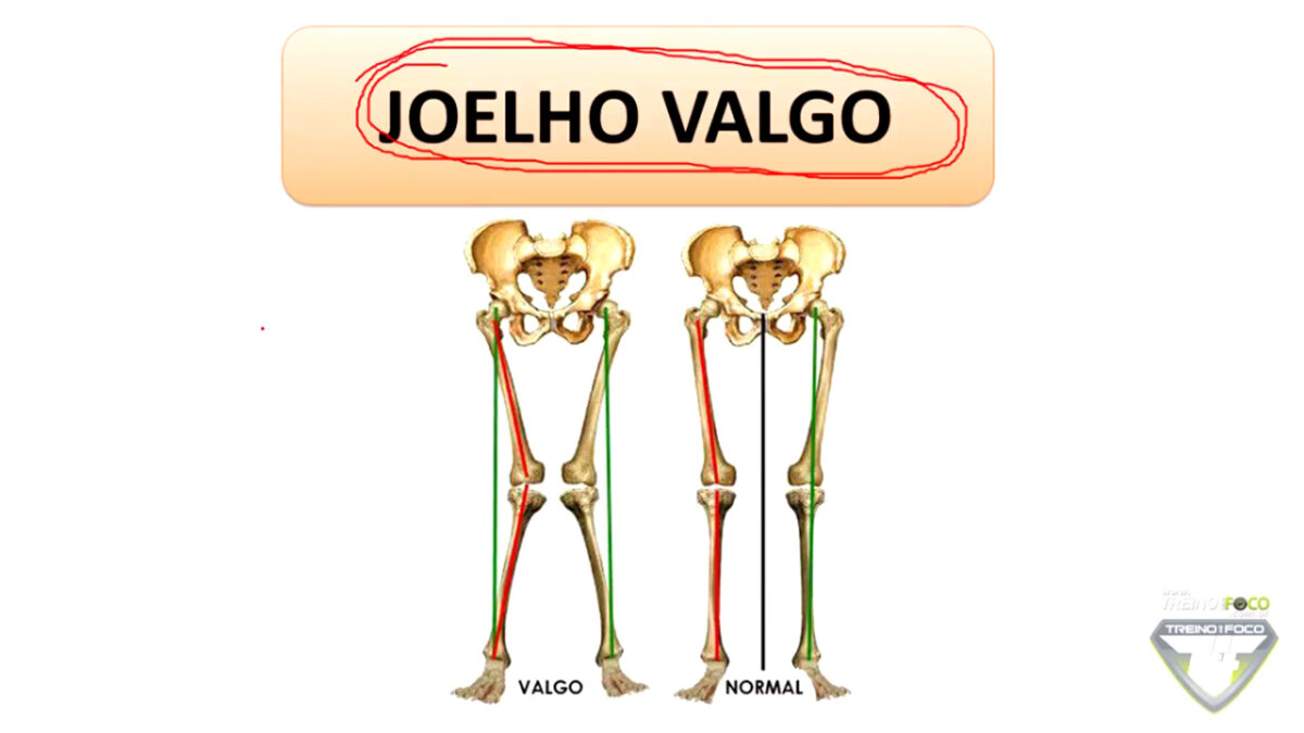 joelho_valgo_biofotogrametria_treino_em_foco_avaliação_postural