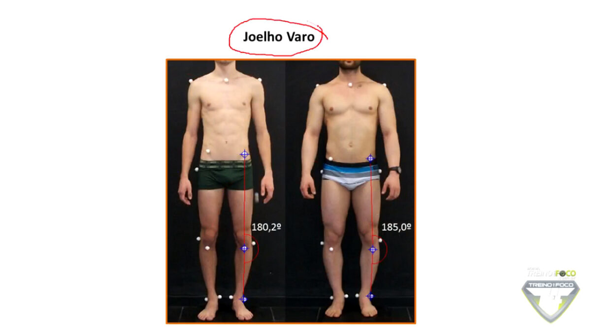 joelho_varo_treino_em_foco_avaliação_postural