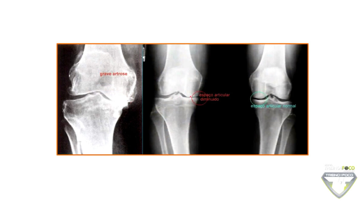 treino_em_foco_avaliação_postural_biofotogrametria_joelho_varo