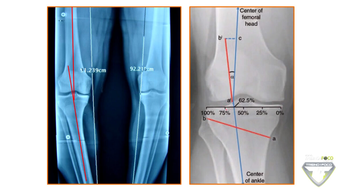 treino_em_foco_radiografia_joelho_varo_avaliação_postural_biofotogrametria