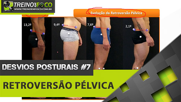 Retroversão pélvica - Como avaliar através da biofotogrametria?