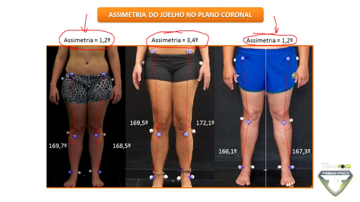 assimetria_de_joelho_desvios_posturais_treino_em_foco_biofotogrametria