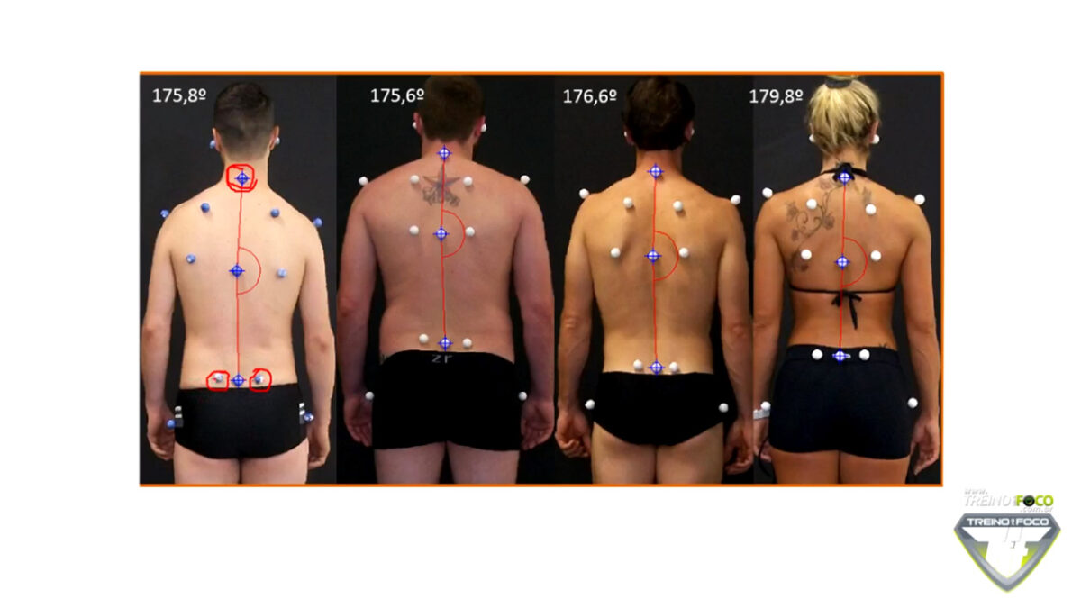 escoliose_treino_em_foco_biofotogrametria_desvio_postural_avaliação_postural