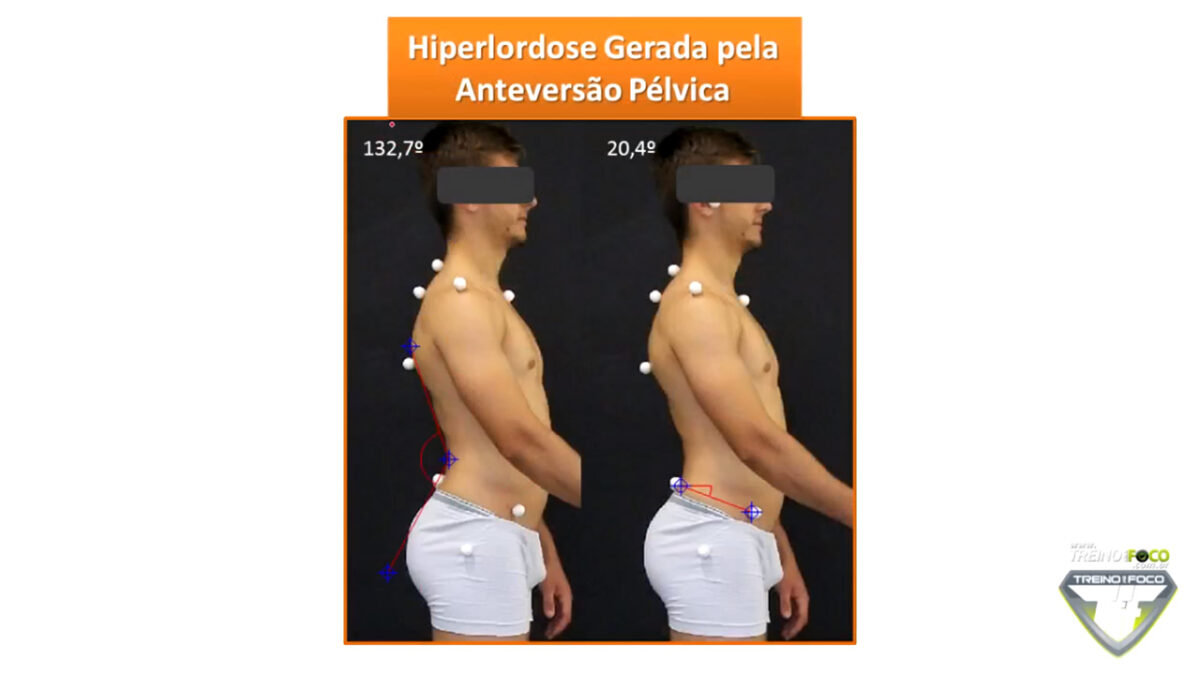 hiperlordose_lombar_treino_em_foco_biofotogrametria_desvios_posturais