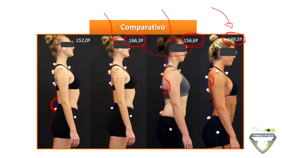 hipocifose_torácica_desvios_posturais_treino_em_foco_biofotogrametria