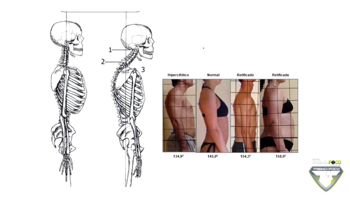 hipocifose_torácica_treino_em_foco_desvios_posturais_biofotogrametria