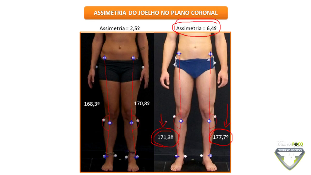 joelho_varo_joelho_valgo_treino_em_foco_assimetria_joelho