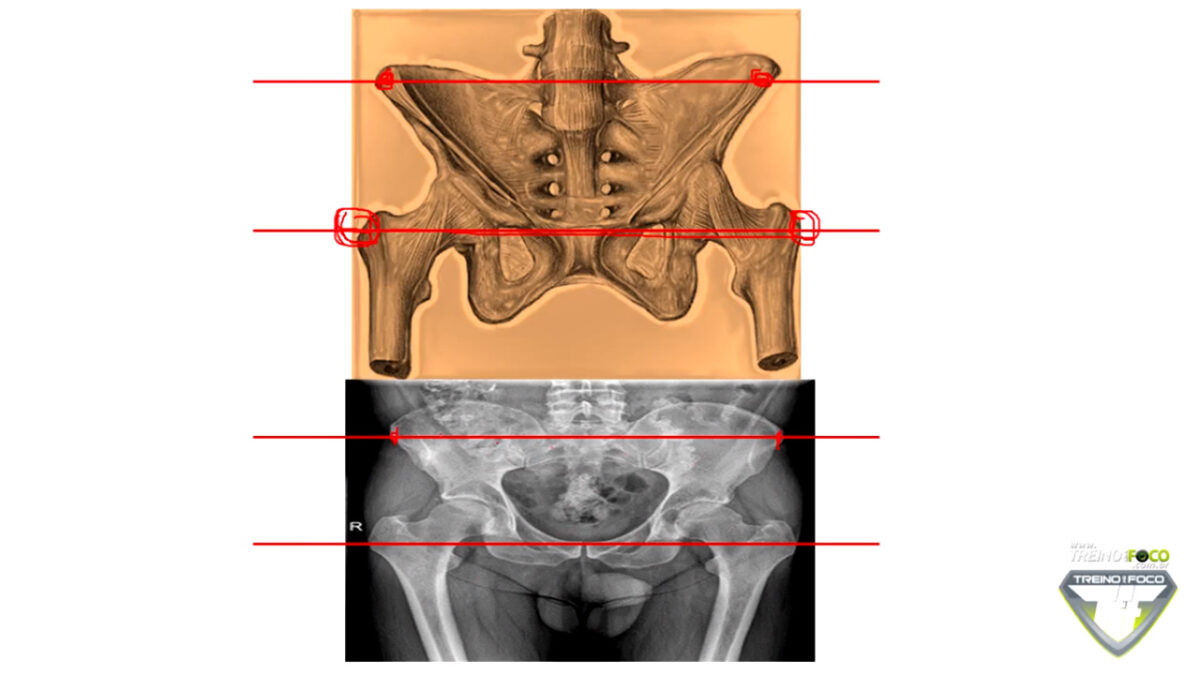 nivelamento_e_desnivelamento_pelve_treino_em_foco_biofotogrametria