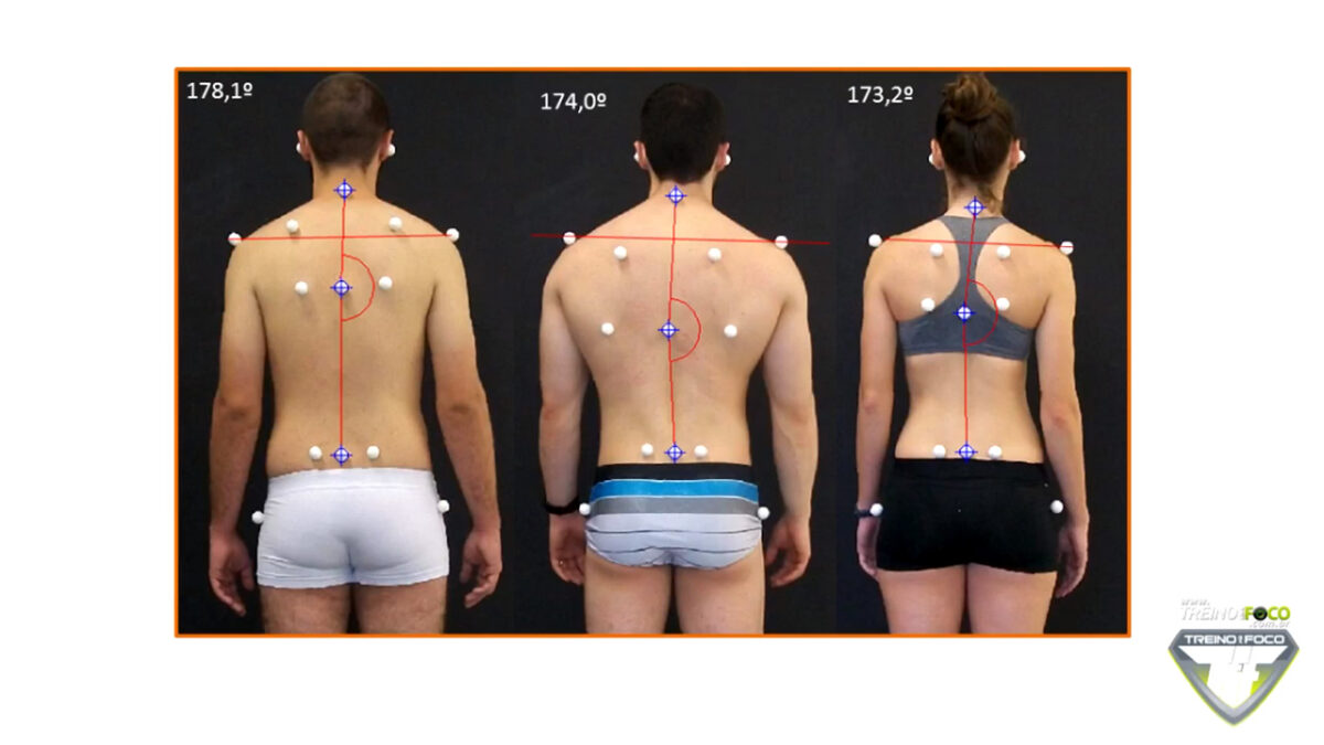 treino_Em_foco_escoliose_desvio_postural_avaliação_postural