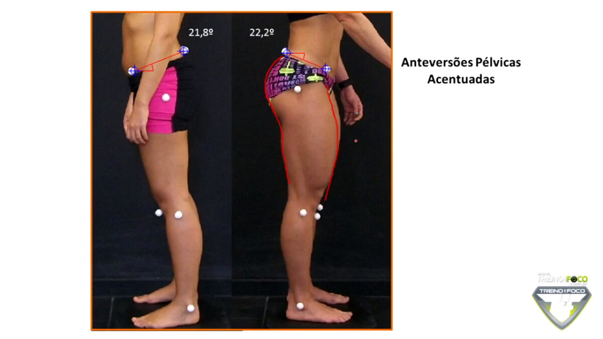 treino_em_foco_anteversão_pélvica_biofotogrametria