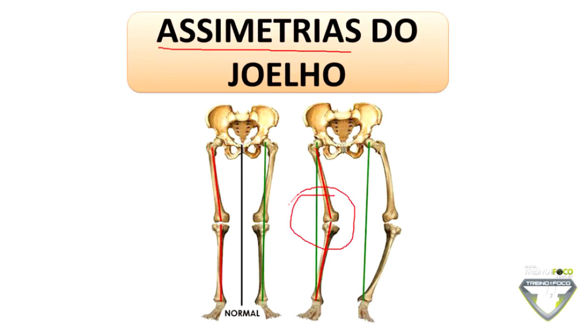 treino_em_foco_assimetria_de_joelho_joelho_varo_valgo_biofotogrametria