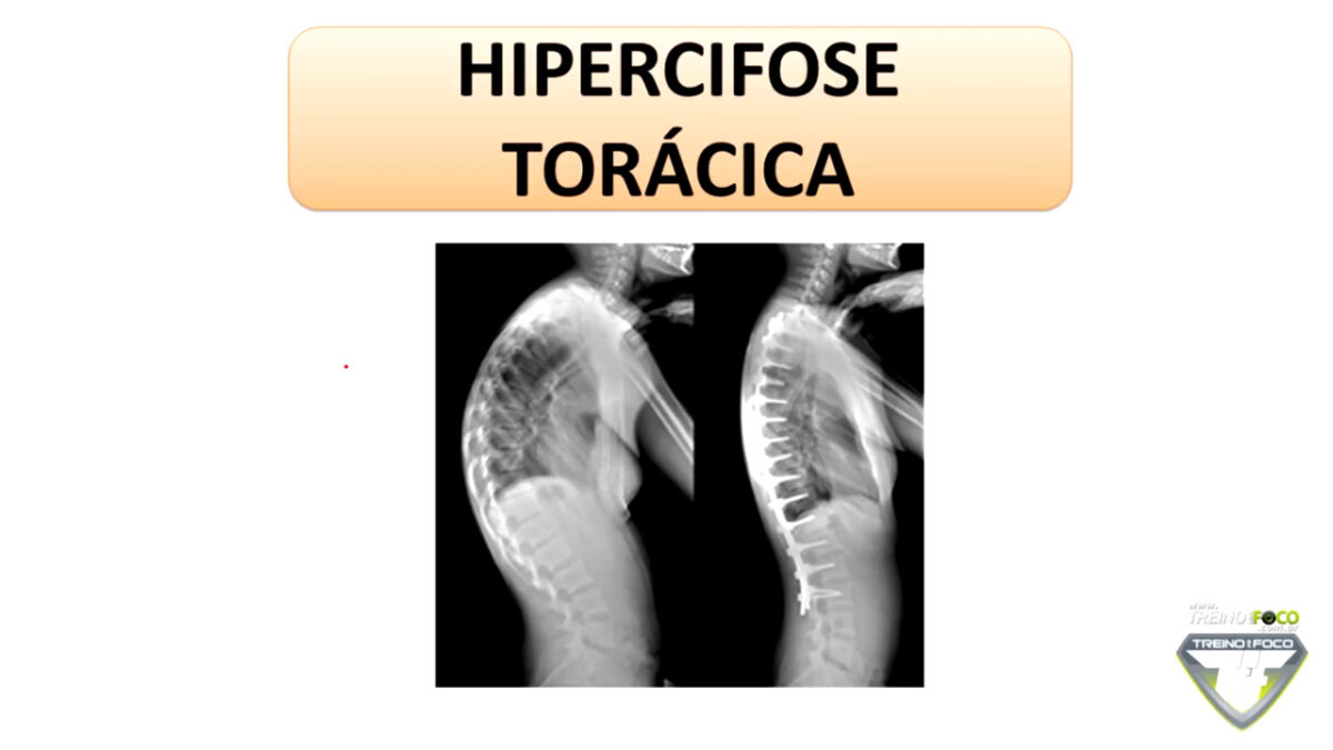 treino_em_foco_hipercifose_torácica_desvios_posturais_biofotogrametria