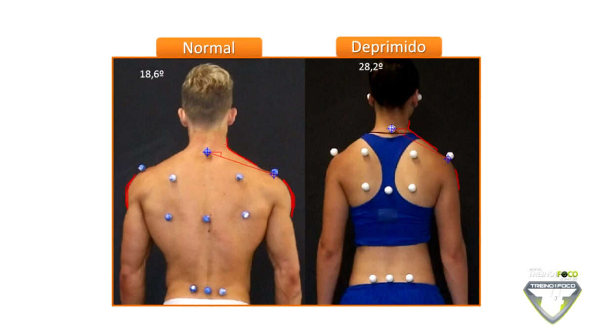 depressão_dos_ombros_ombros_deprimidos_treino_em_foco_biofotogrametria