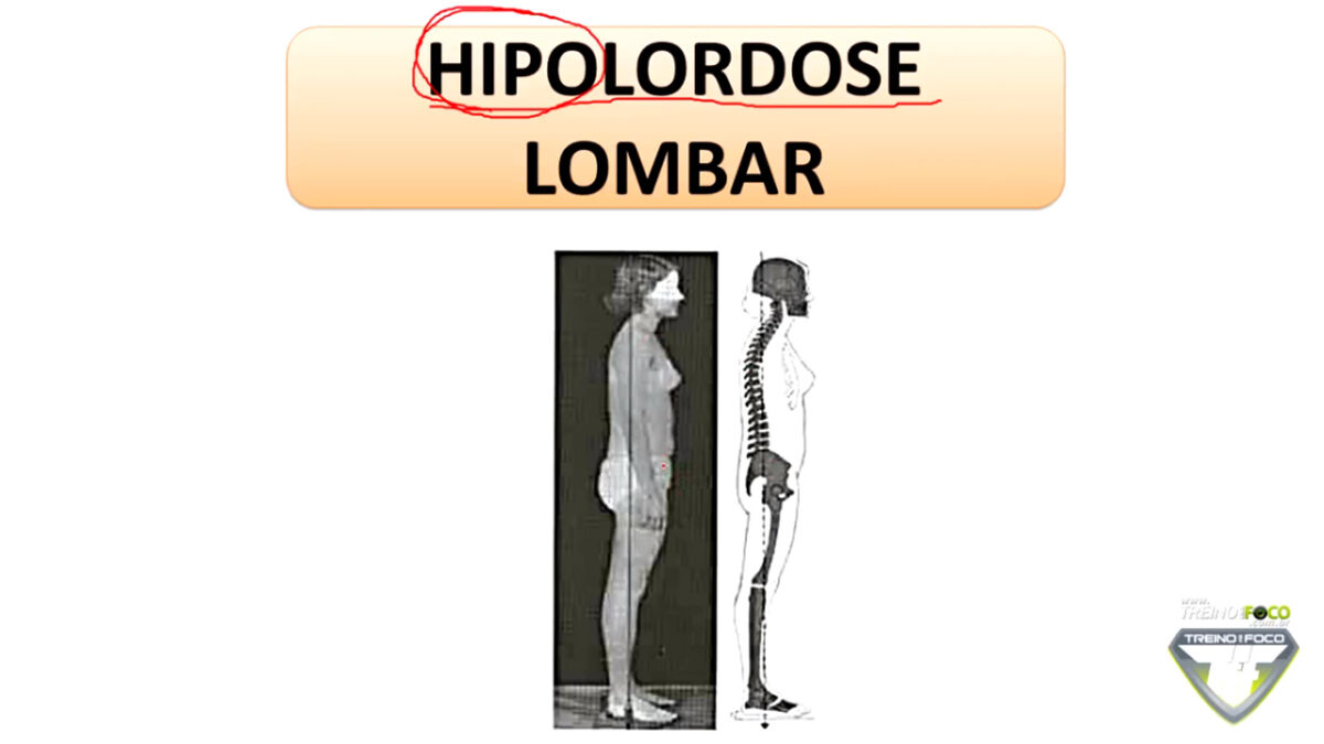 hipolordose_lombar_desvios_posturais_treino_em_foco_biofotogrametria