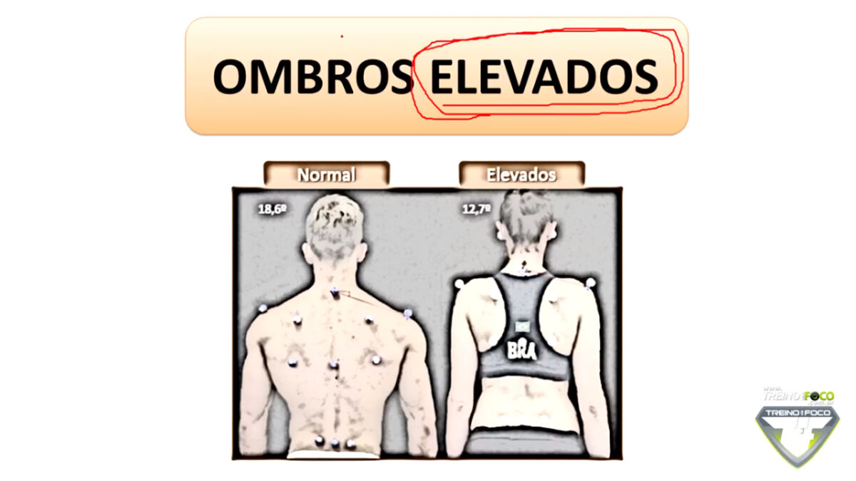 treino_em_foco_ombros_elevados_desvios_posturais_biofotogrametria