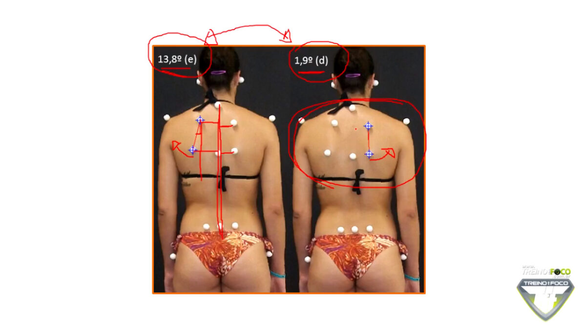 assimetria_rotatória_das_escápulas_treino_em_foco_desvios_posturais_