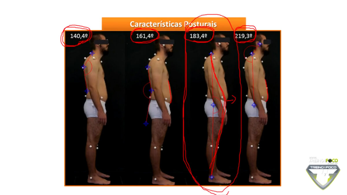 biofotogrametria_treino_em_foco_postura_desleixada_alterações_posturais_