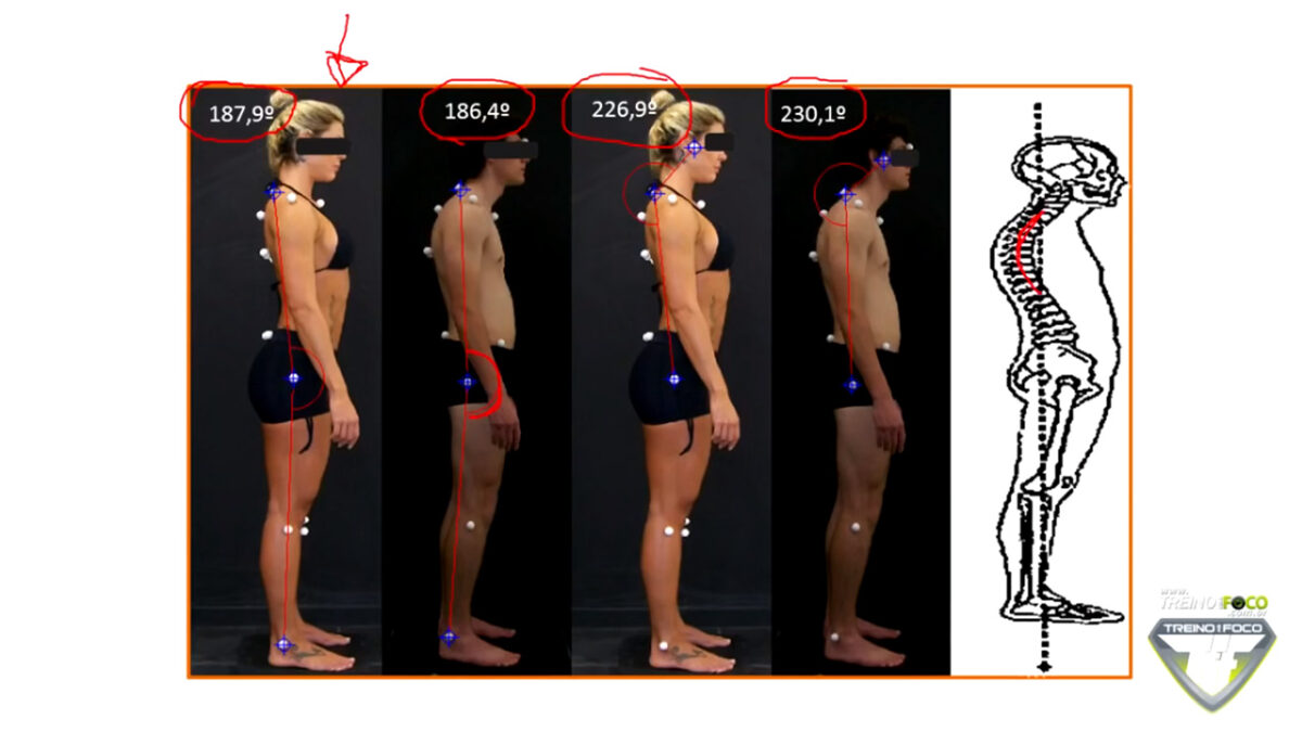 desvios_posturais_treino_em_foco_biofotogrametria_postura_desleixada