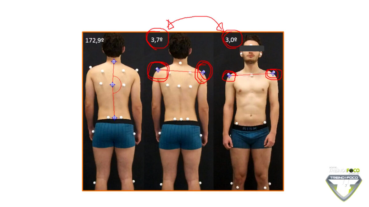 treino_em_foco_desnivelamento_dos_ombros_avaliação_postural_biofotogrametria_