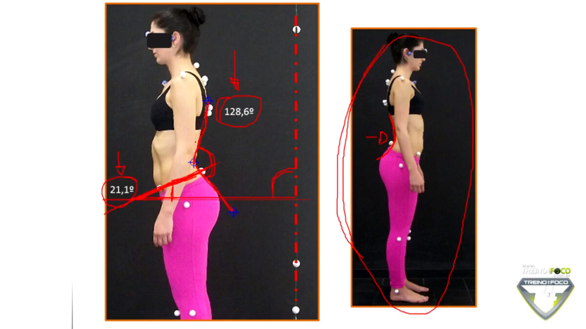 treino_em_foco_desvios_posturais_hiperlordose_lombar_anterevrsao_pelvica