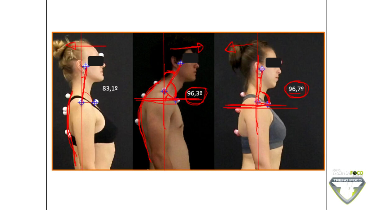 biofotogrametria_treino_em_foco_desvios_posturais_cifose_toracica