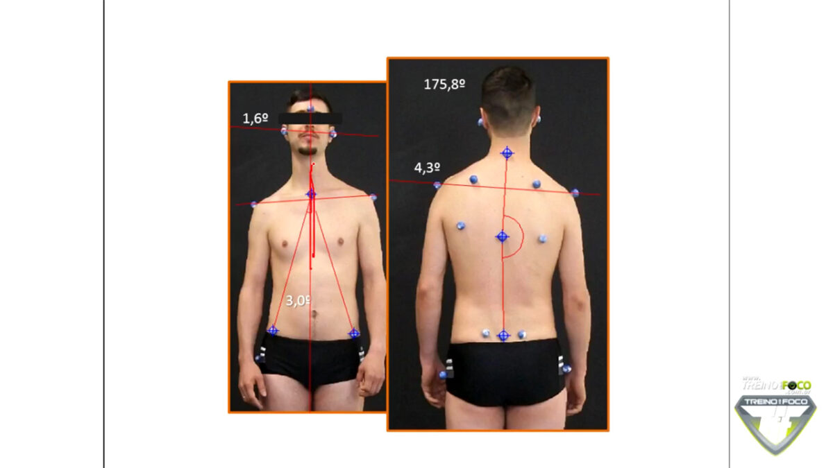 escoliose_desvios_posturais_treino_em_foco_plano_coronal