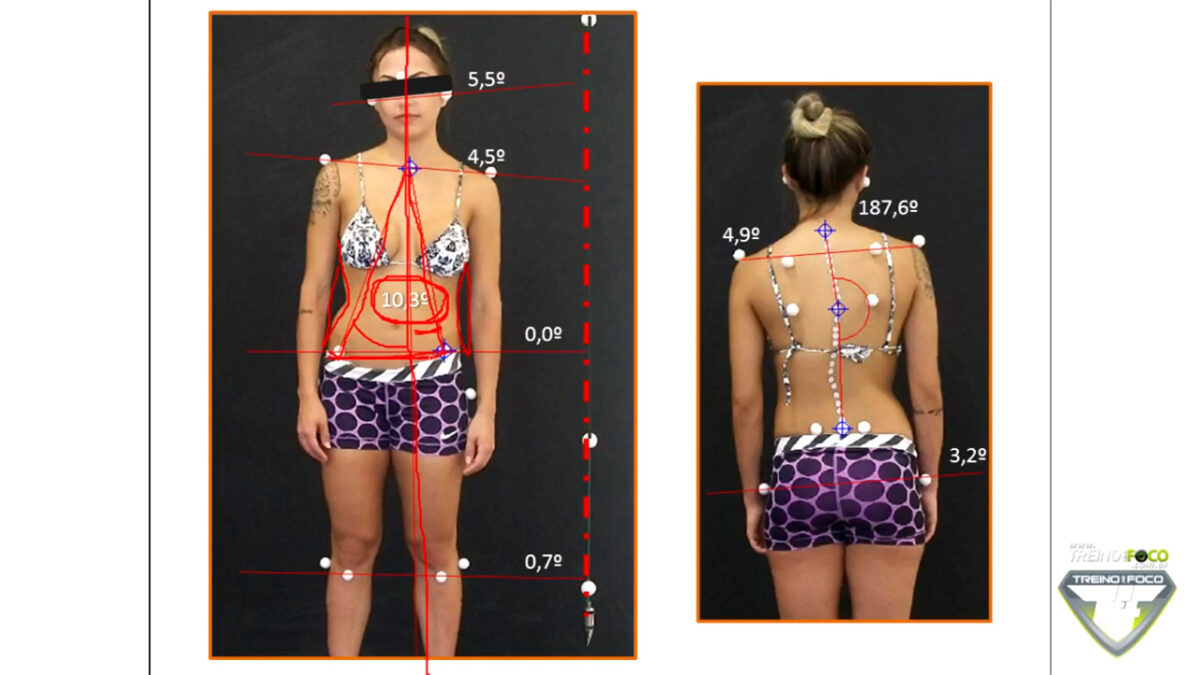 treino_em_foco_desvios_postruais_plano_coronal_escoliose