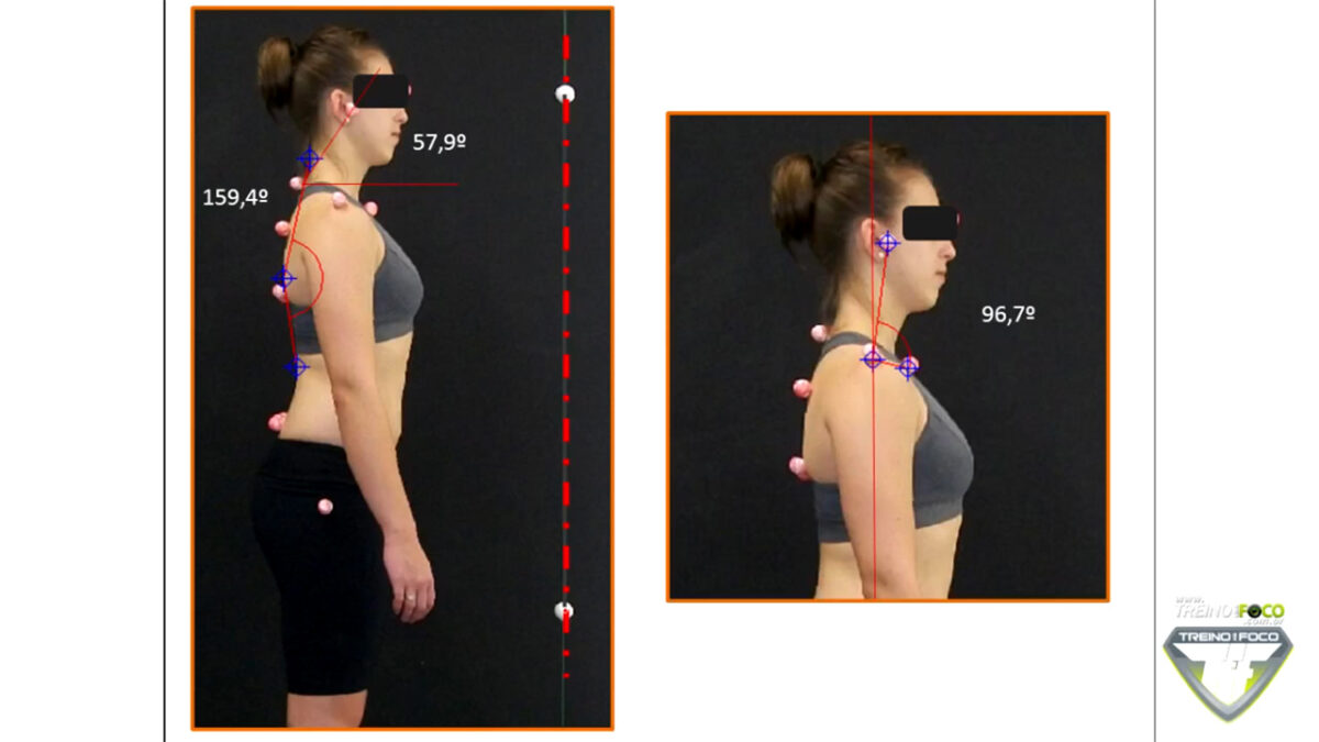 treino_em_foco_desvios_posturais_cifose_toracica_