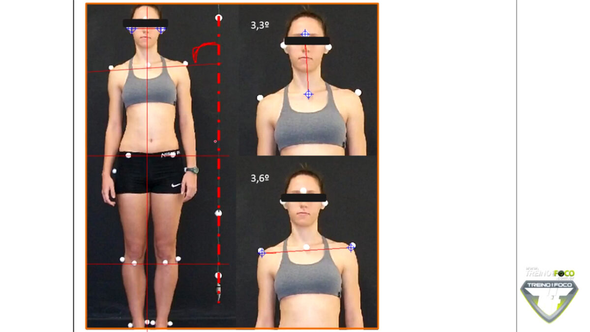 treino_em_foco_desvios_posturais_escoliose_plano_coronal