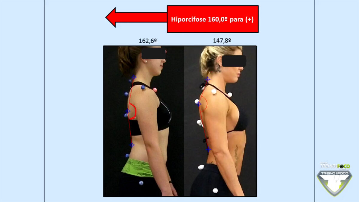 hipocifose_toracica_treino_em_foco