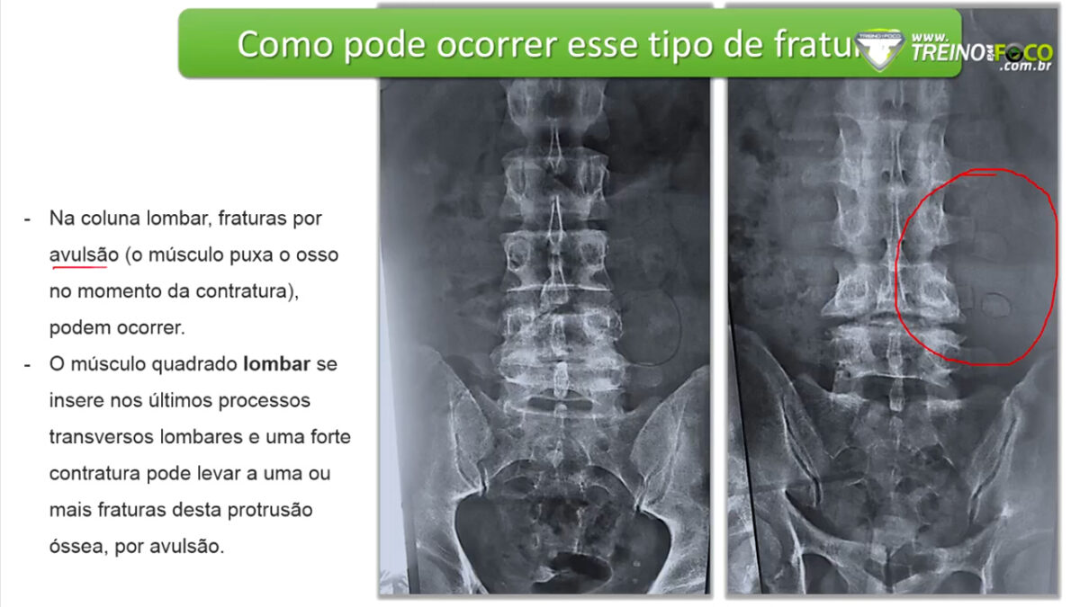 lesao_corpos_vertebrais_coluna_vertebral_treino_em_foco