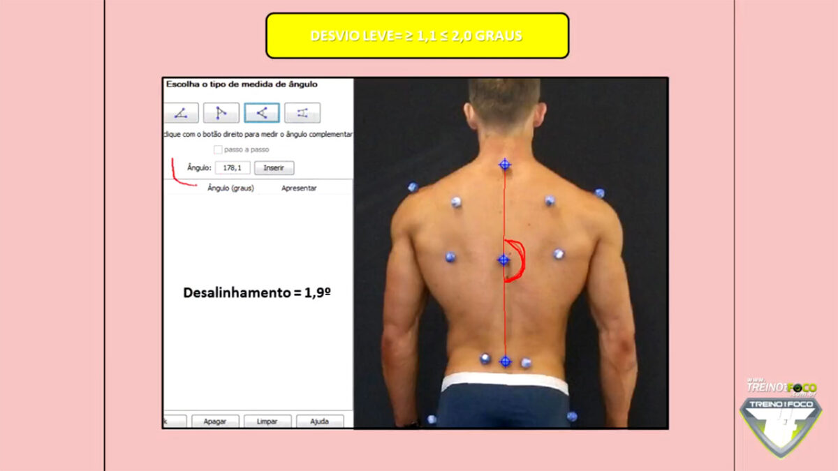 posterior_escoliose_treino_em_foco_referencias_biofotogrametrias