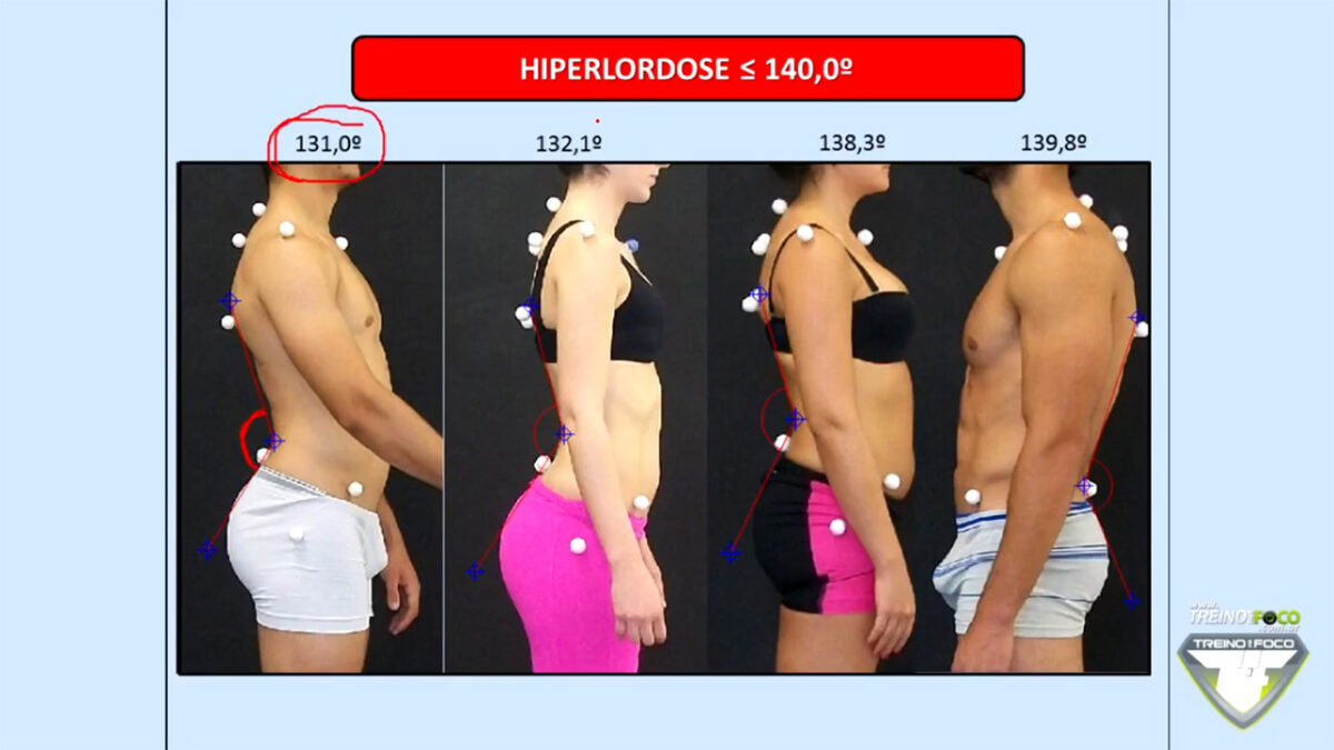 treino_em_foco_hiperlordose_lombar_referencias_biofotogrametricas_clinicas