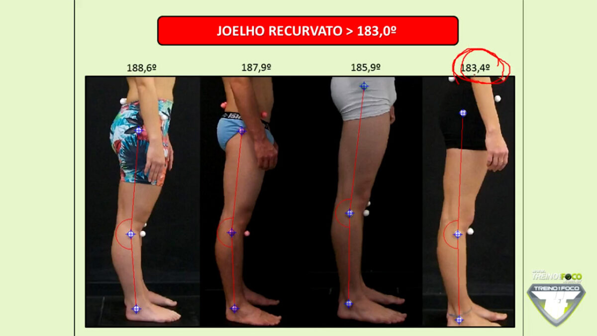 treino_em_foco_joelho_recurvato_referencias_biofotogrametricas