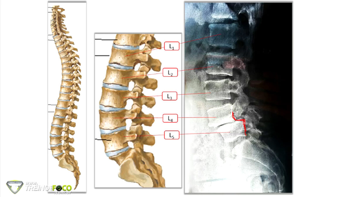 espondilólise_espondilolistese_treino_em_foco_coluna_vertebral