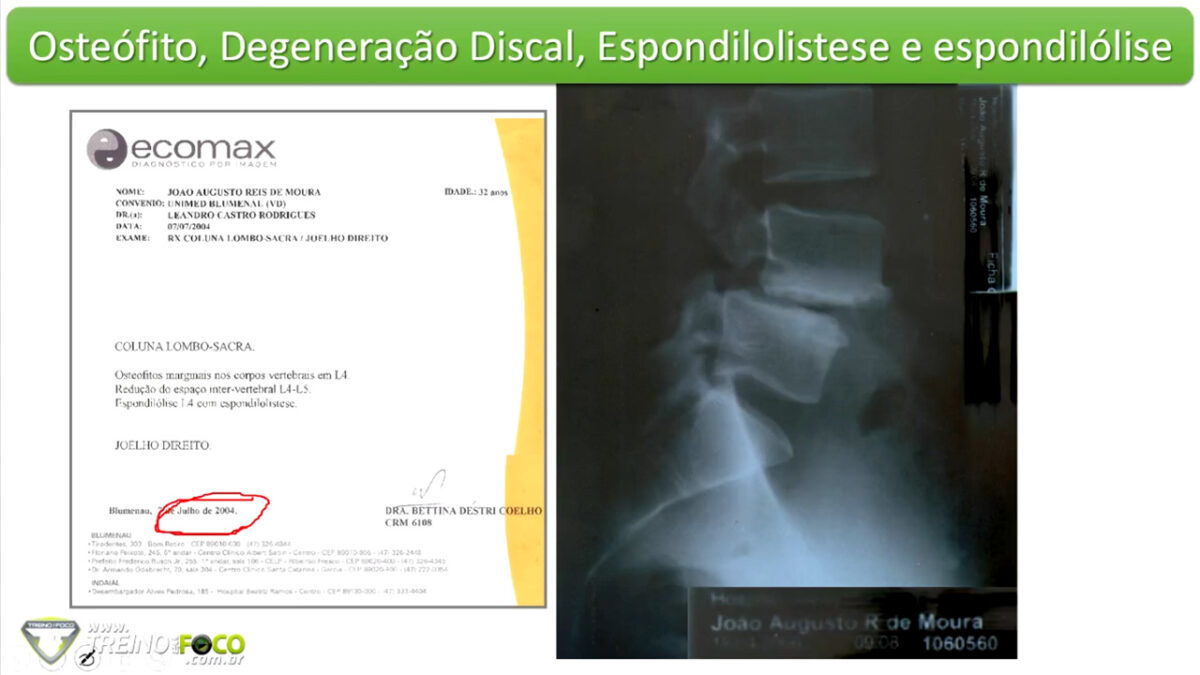 osteófilos_treino_em_foco_patologia_coluna_vertebral