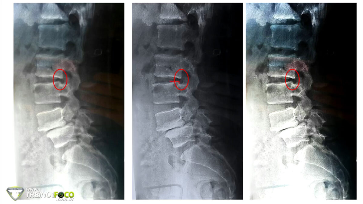 treino_em_foco_coluna_vertebral