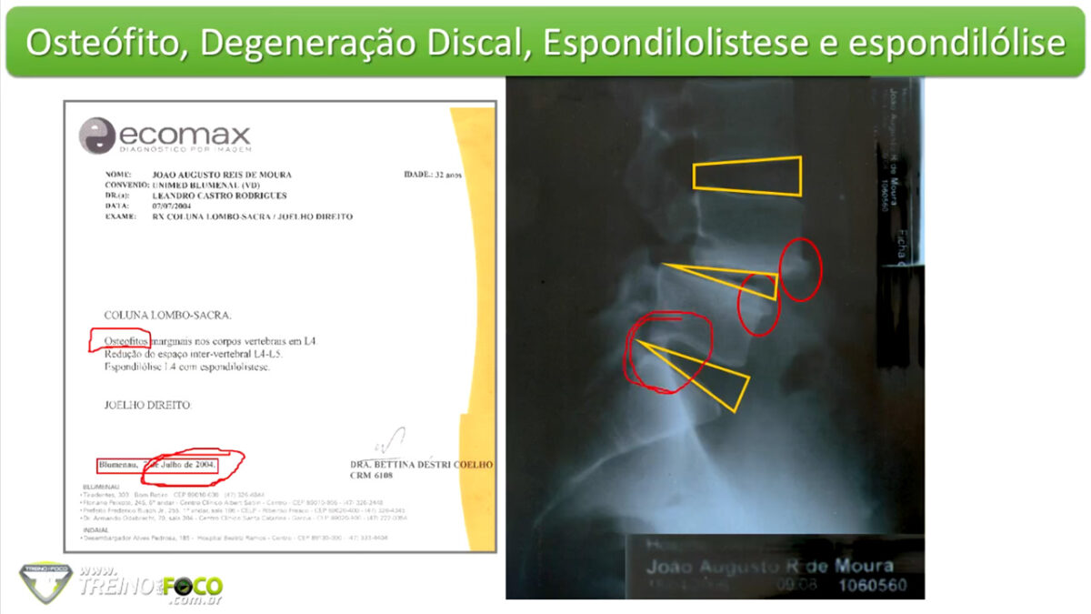 treino_em_foco_patologia_coluna_vertebral_espondilolistese_espondilólise