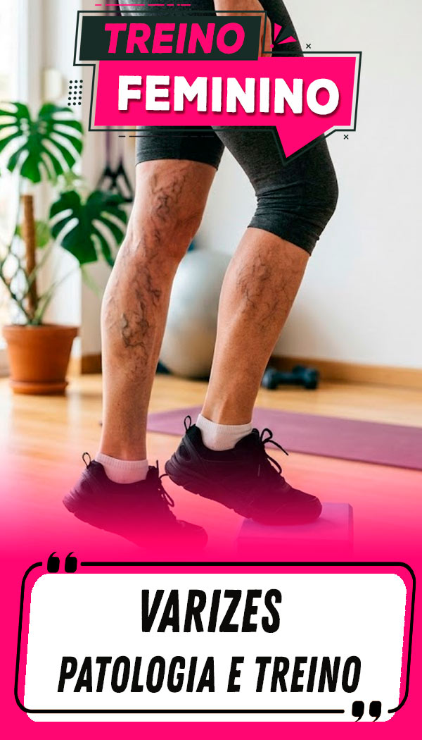 1 - Varizes - Patologia e Treino